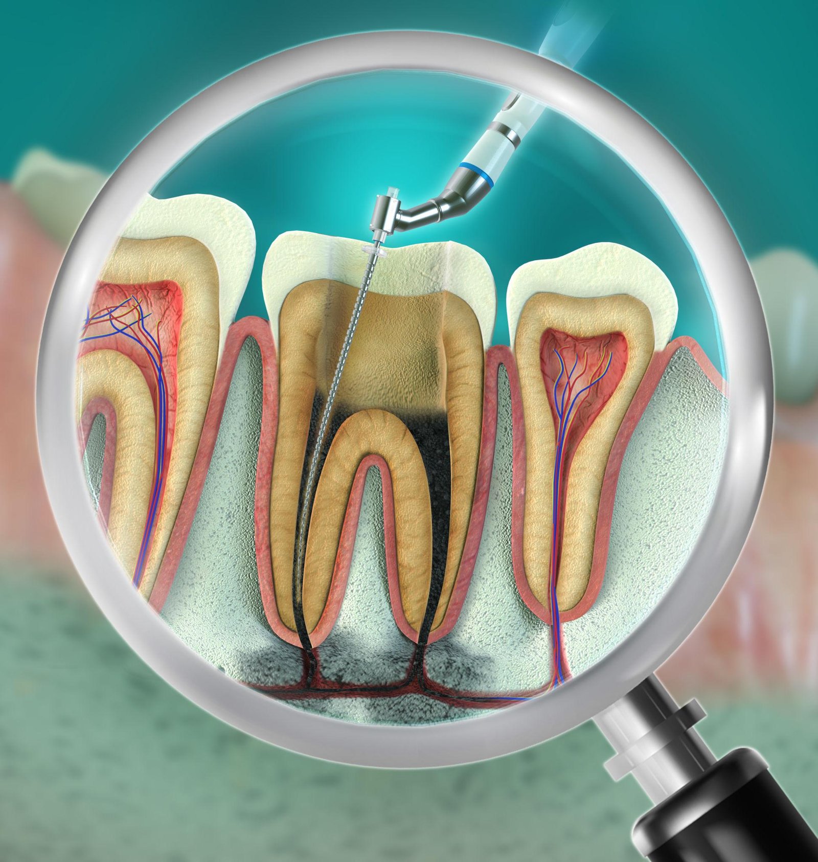 Endodontic dental care